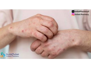 أسباب الأرتيكاريا المزمنة وطرق علاجها