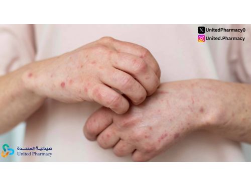 أسباب الأرتيكاريا المزمنة وطرق علاجها