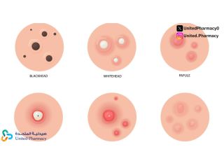 أسباب ظهور حبوب في الجسم وكيفية التخلص منها بسرعة