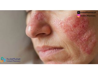 الحساسية الوردية: الأعراض وطرق العلاج والوقاية