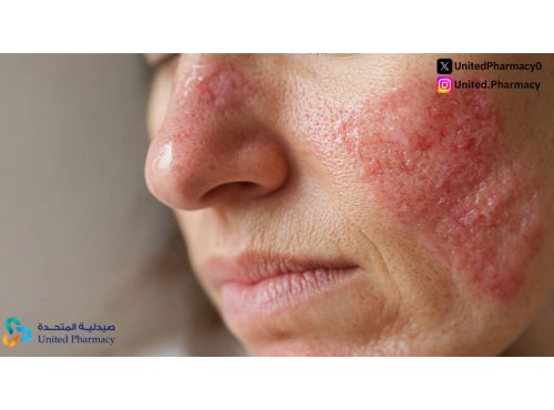 الحساسية الوردية: الأعراض وطرق العلاج والوقاية