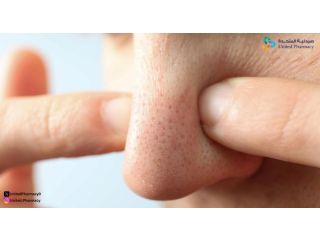 علاج المسامات من الصيدلية
