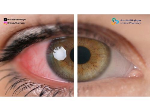 متى يكون التهاب العين خطير