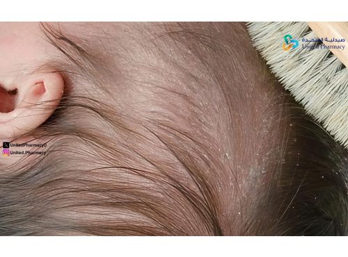 أسباب قشرة الشعر عند الأطفال​​​