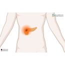 اعراض سرطان البنكرياس​