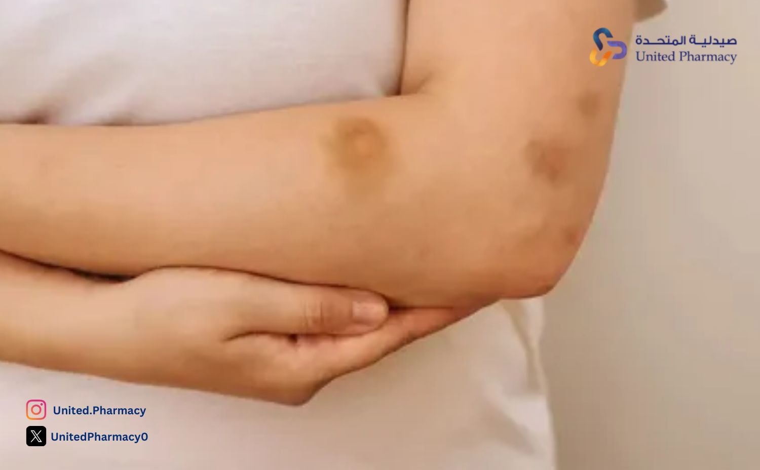 ظهور كدمات حمراء في الجسم بدون سبب