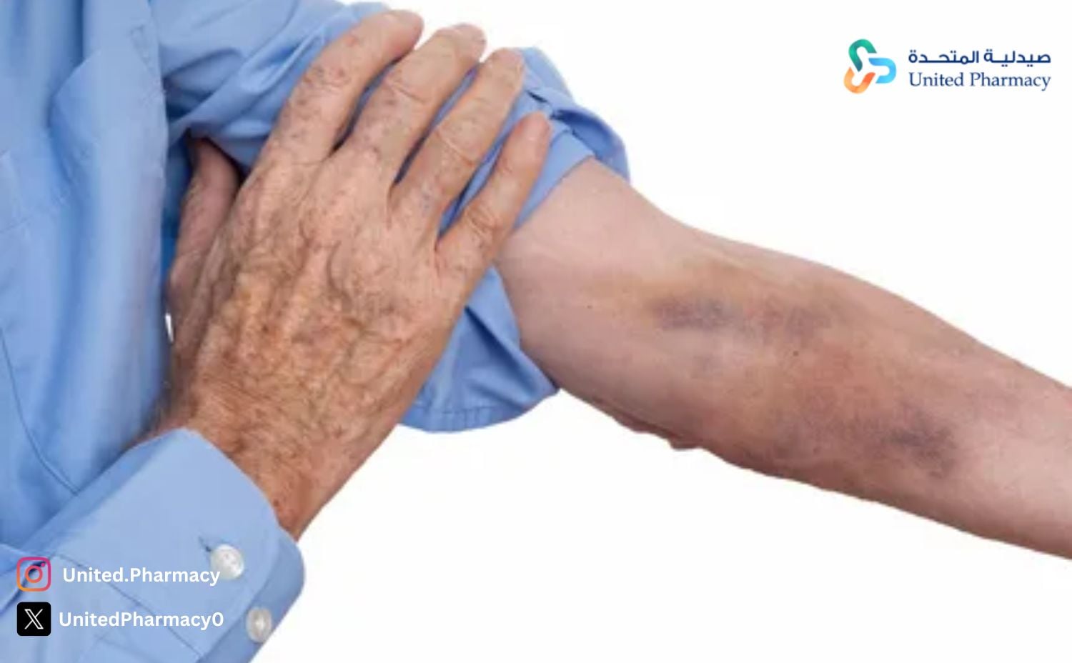 ظهور كدمات في اليد بدون سبب