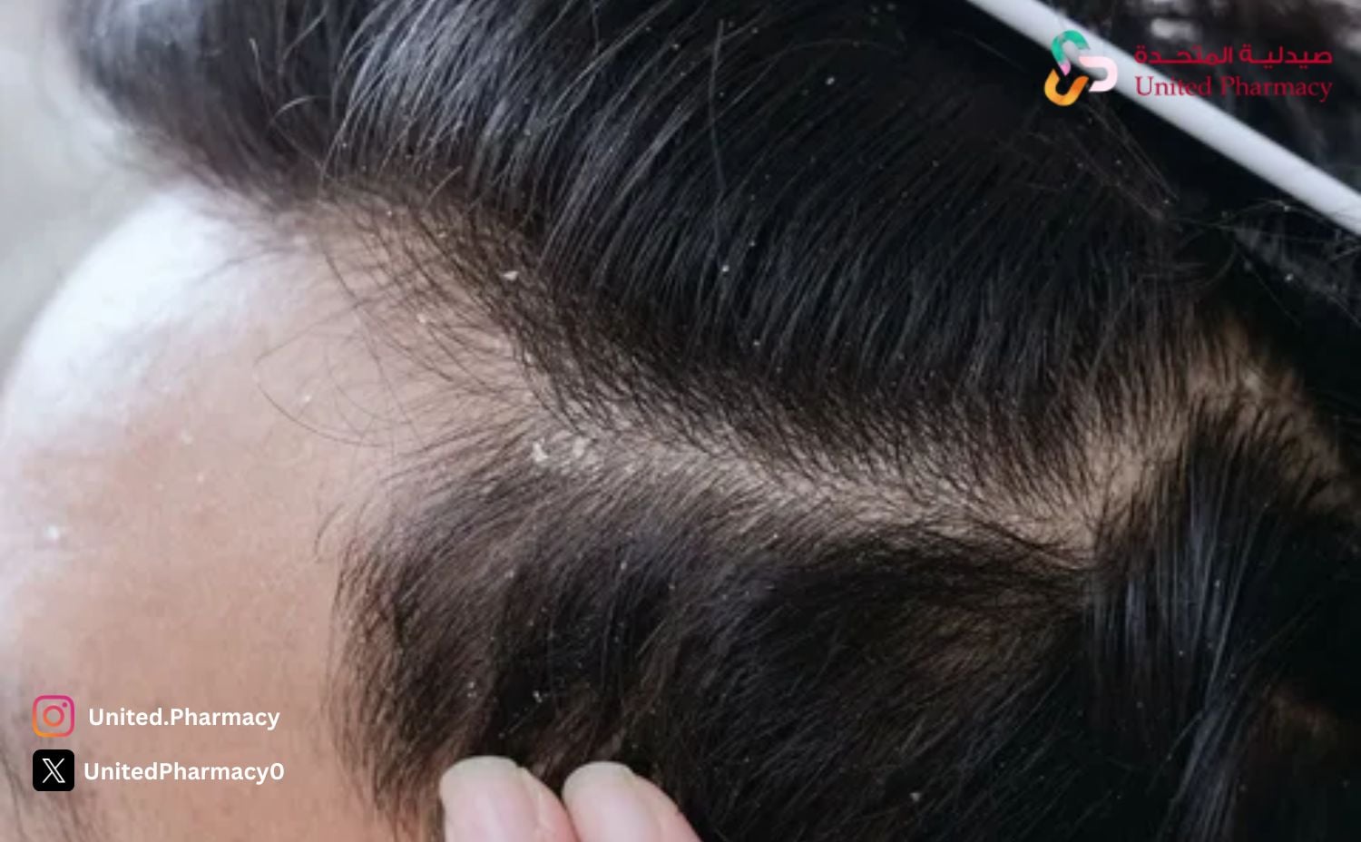 أنواع قشرة الشعر
