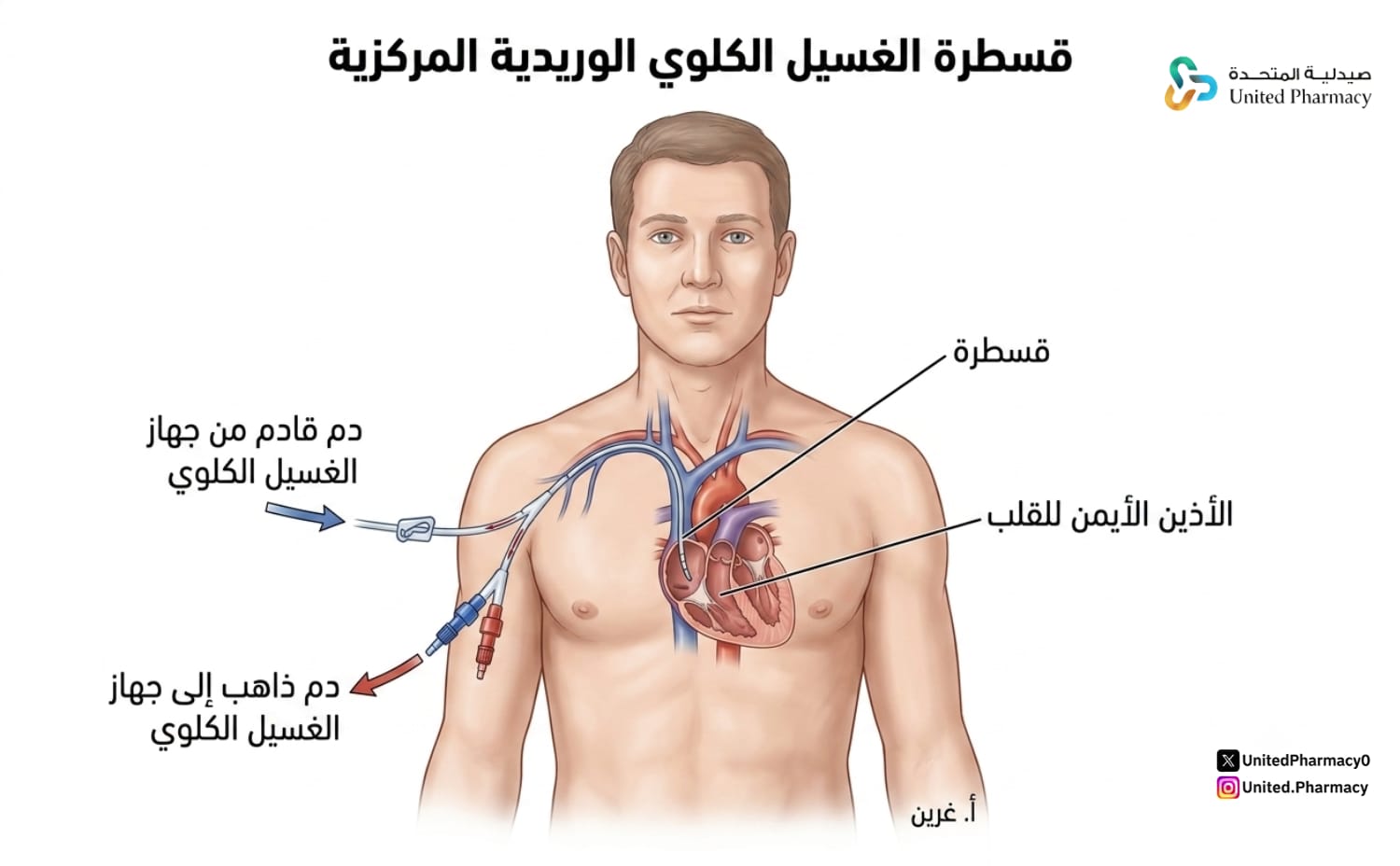 قسطرة الغسيل الكلوي
