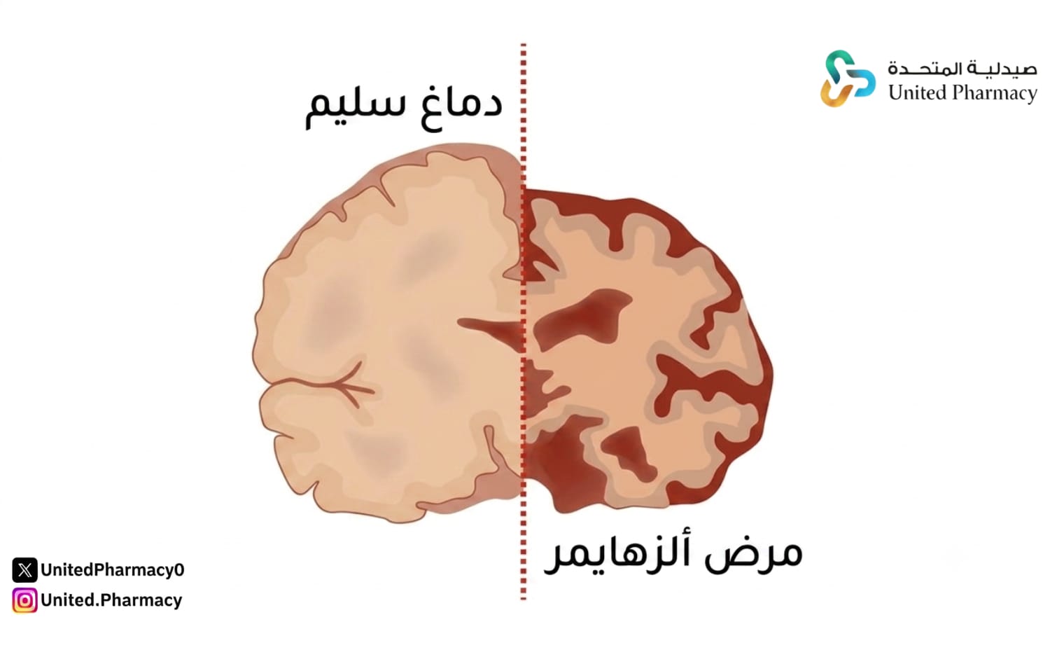 تشخيص الزهايمر