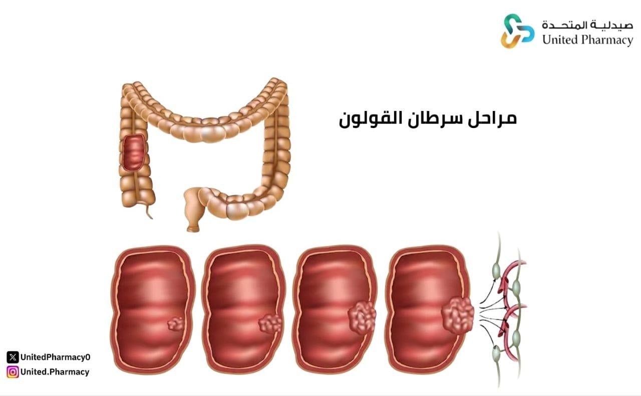 مراحل سرطان القولون