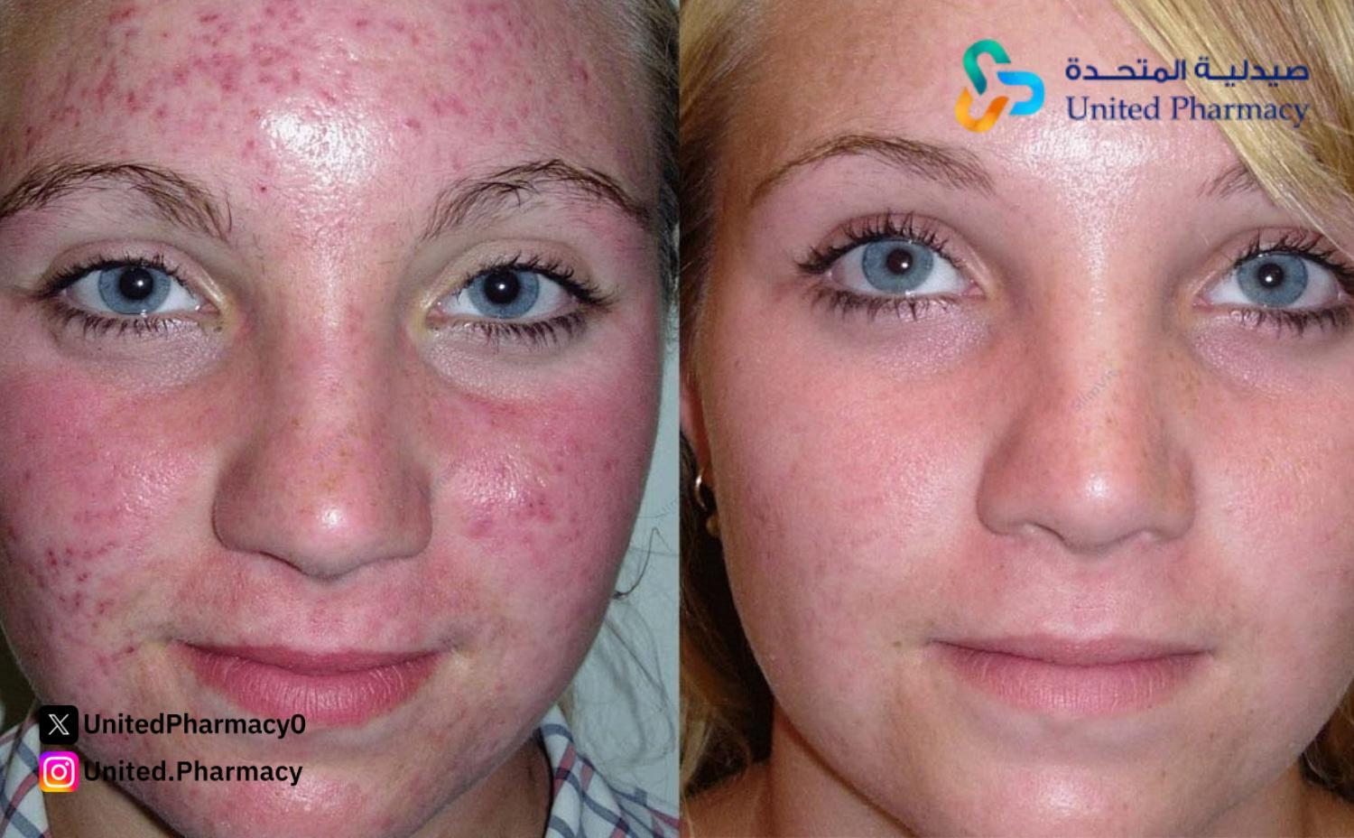 كريم فيوسيدين للوجه