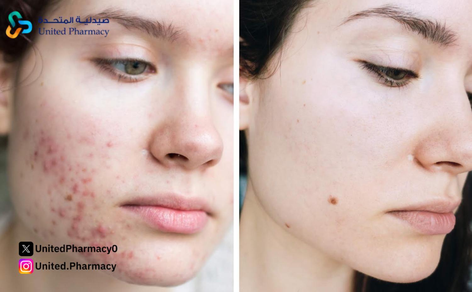 إزالة حبوب الشباب