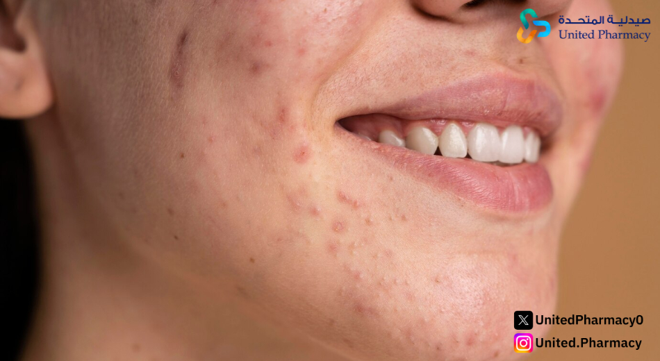 متى يبدأ مفعول حبوب تابوسين لحب الشباب